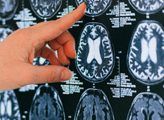 Enfermedades cerebrovasculares: cada minuto cuenta Enfermedades cerebrovasculares: cada minuto cuenta
